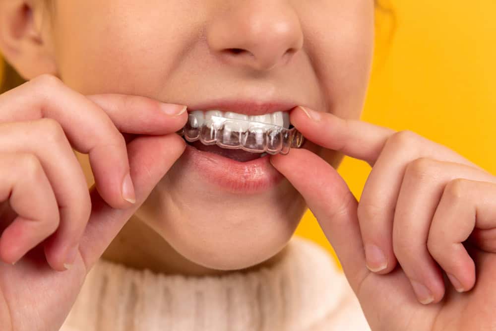 Clear braces in austin clear braces in austin
