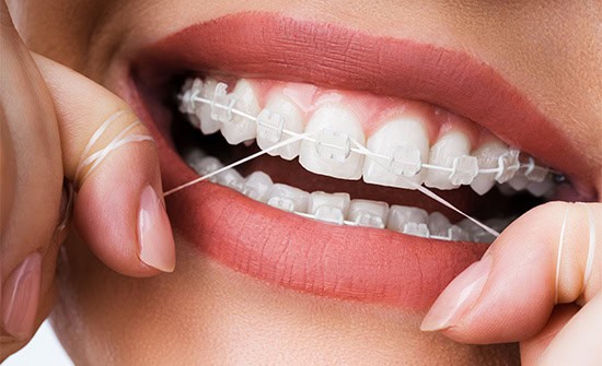 braces flossing tips