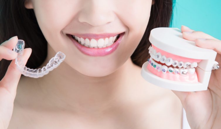 Clear vs. Traditional Braces: Which Is Best for You?