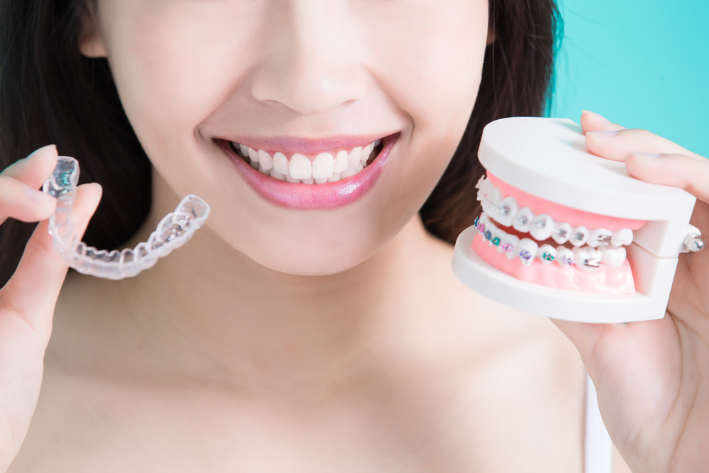Clear vs. Traditional Braces: Which Is Best for You?