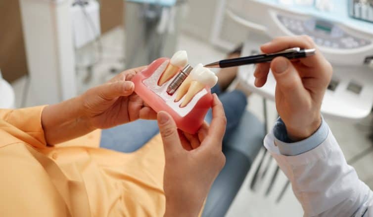 Dental Implants vs. Veneers: Longevity & Care Compared