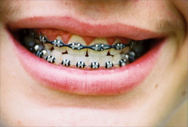 Choosing the Right Braces for You: Insights and Guidance