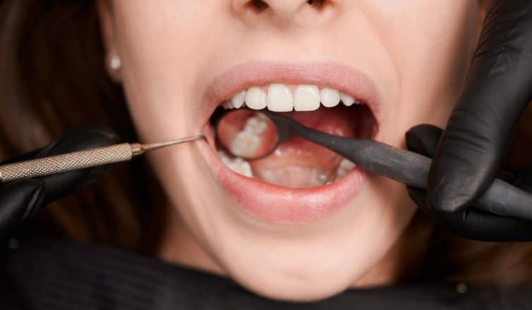 Secrets to a Beautiful Smile with Tooth Colored Fillings