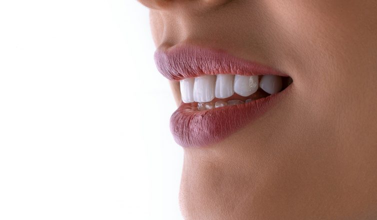What to Expect After Getting Dental Implants