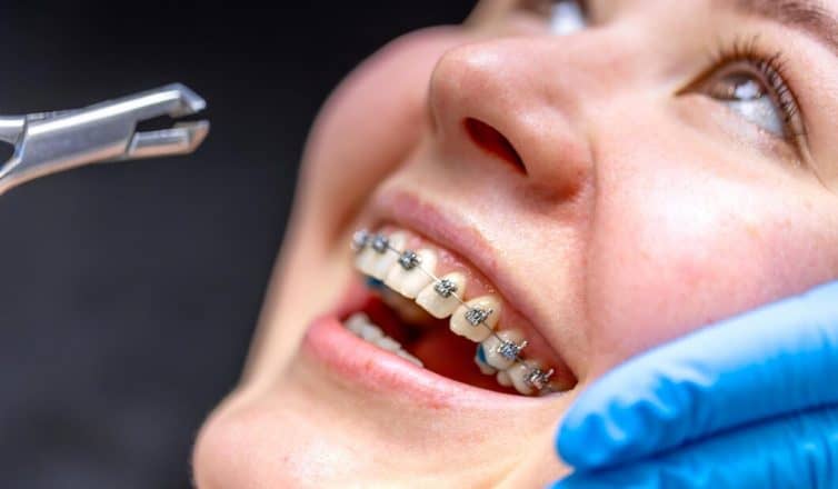 Top Questions About Getting Braces Answered