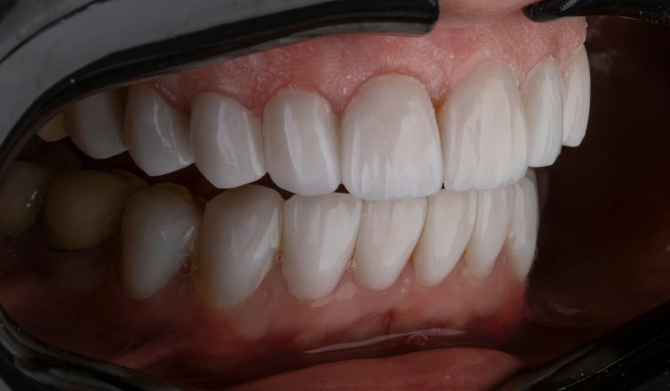 Porcelain vs Composite Veneers: Pros and Cons