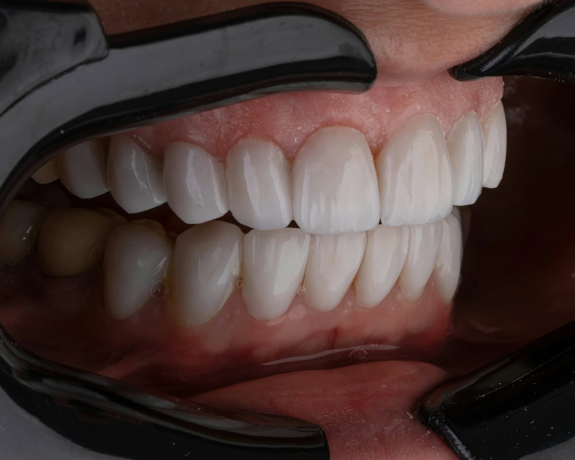 Porcelain vs Composite Veneers: Pros and Cons
