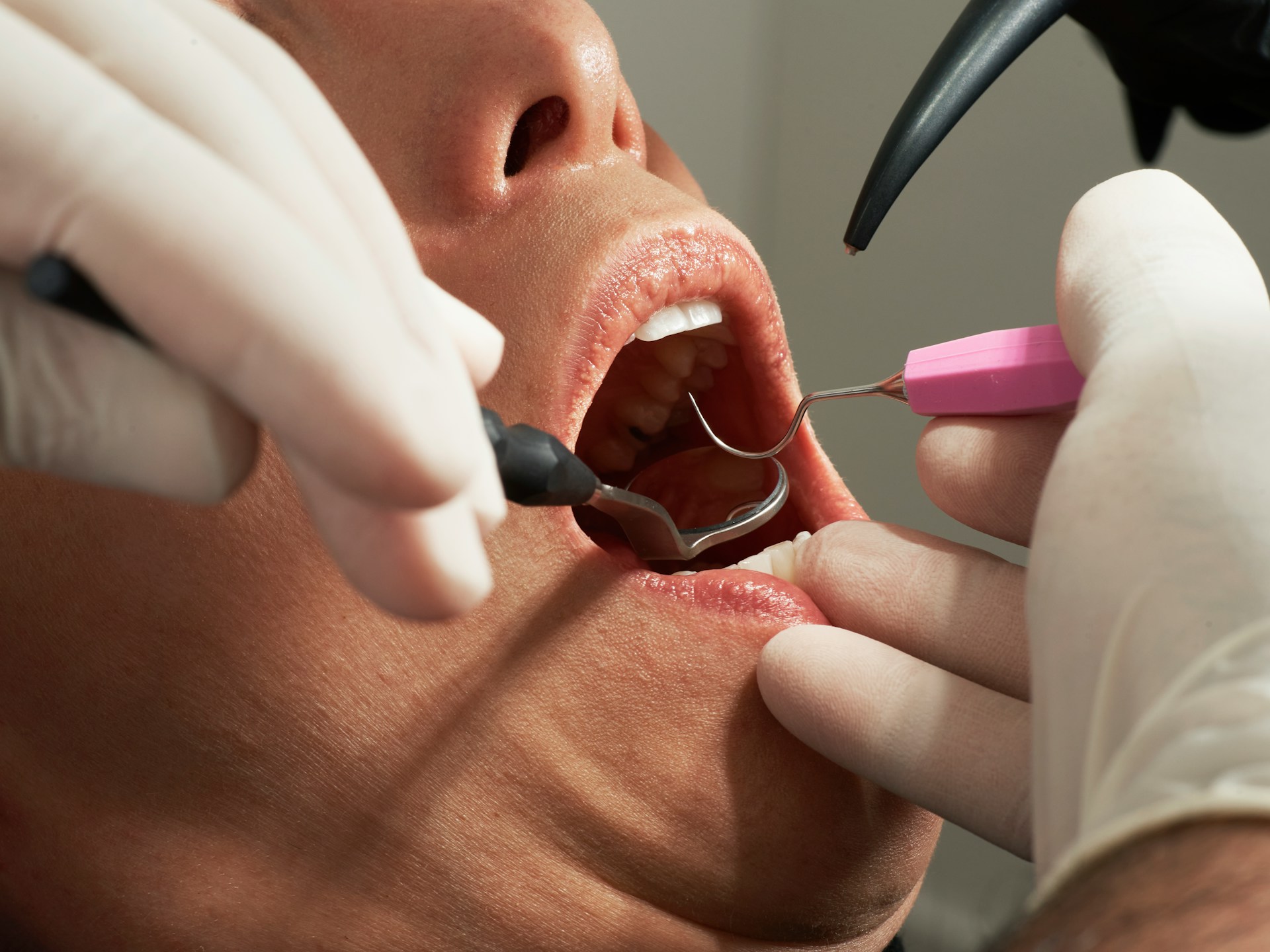 When Is the Right Time to Replace Your Dental Crown