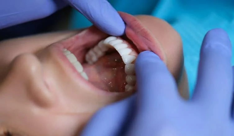 Addressing Food Restrictions With New Dental Veneers