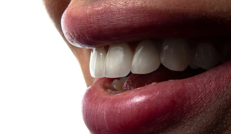 Why Your Tooth-Colored Fillings Might Be Changing Color